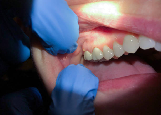 Best Urgent Care for Lost Fillings or Crowns in Teutopolis, IL